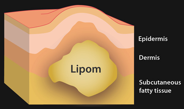 lipom EN:  (© )